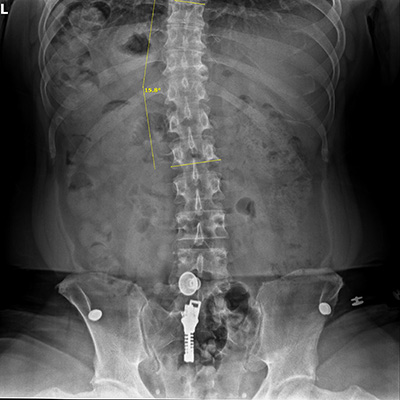 Huntersville NC Mild Scoliosis Huntersville NC Mild Scoliosis