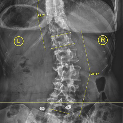 Huntersville NC Moderate Scoliosis Huntersville NC Moderate Scoliosis