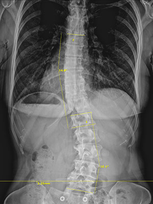 Huntersville NC Scoliosis Kate After 14 19 Huntersville NC Scoliosis Kate After 14 19