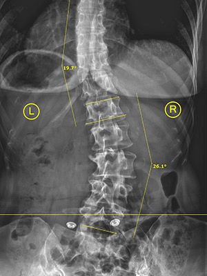 Huntersville NC Scoliosis Kate Before 19 26 Huntersville NC Scoliosis Kate Before 19 26