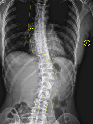 Huntersville NC Scoliosis Kight After 17 25 Huntersville NC Scoliosis Kight After 17 25