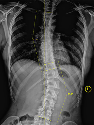 Huntersville NC Scoliosis Kight Before 22 34 Huntersville NC Scoliosis Kight Before 22 34
