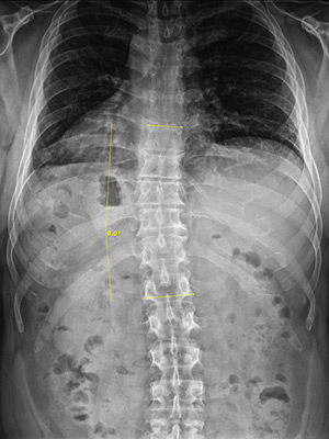 Huntersville NC Scoliosis farellamay After 8 Huntersville NC Scoliosis farellamay After 8