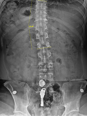 Huntersville NC Scoliosis farellamay Before 15 Huntersville NC Scoliosis farellamay Before 15