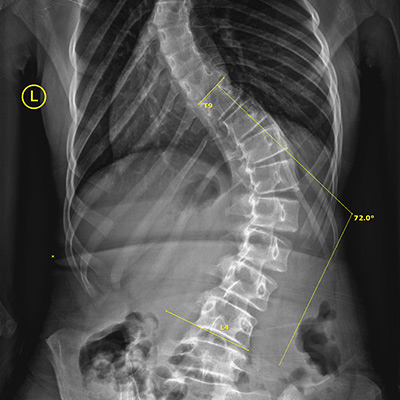Huntersville NC Severe Scoliosis Huntersville NC Severe Scoliosis