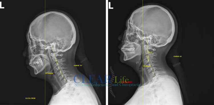 Chiropractic Huntersville NC Before and After 01 Chiropractic Huntersville NC Before and After