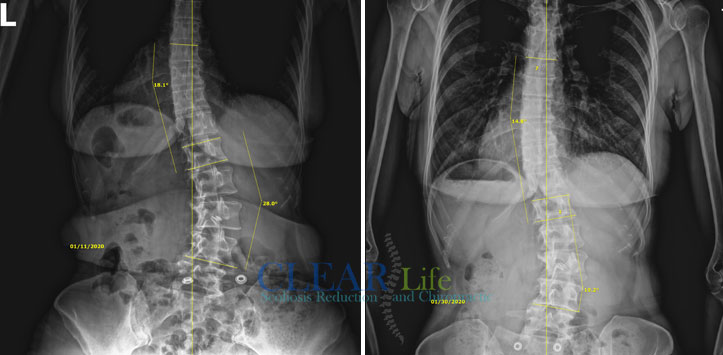 Scoliosis-Huntersville-Before-And-After-03 Chiropractic Huntersville NC Before and After