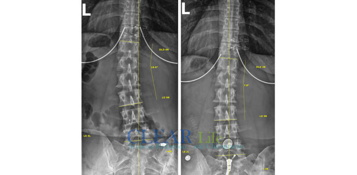 Scoliosis-Huntersville-Before-And-After-14 Chiropractic Huntersville NC Before and After