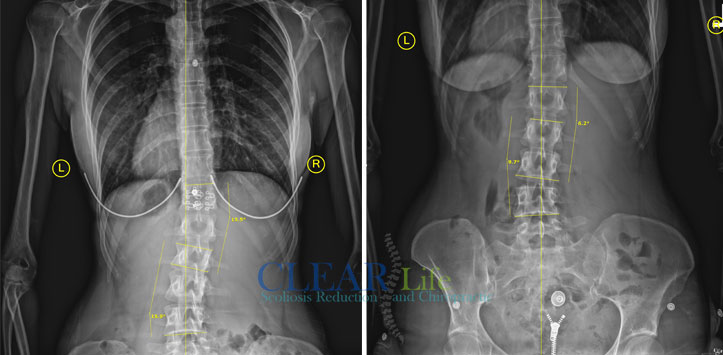 Scoliosis-Huntersville-Before-And-After-15 Chiropractic Huntersville NC Before and After