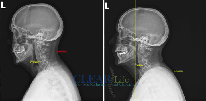 Scoliosis-Huntersville-Before-And-After-16 Chiropractic Huntersville NC Before and After