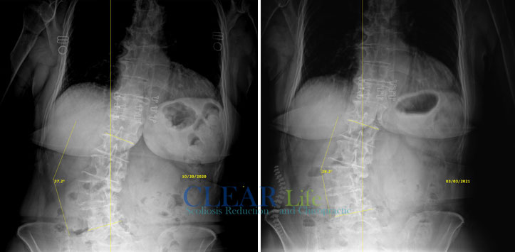 Scoliosis-Huntersville-Before-And-After-17 Chiropractic Huntersville NC Before and After