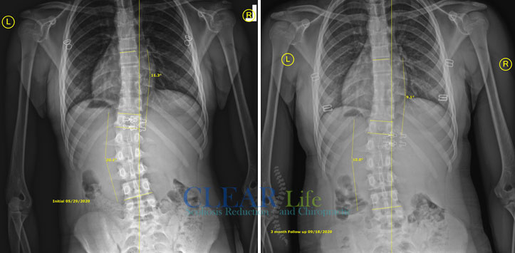 Scoliosis-Huntersville-Before-And-After-18 Chiropractic Huntersville NC Before and After