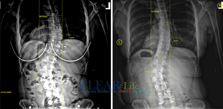 Scoliosis-Huntersville-Before-and-After-02 Chiropractic Huntersville NC Before and After